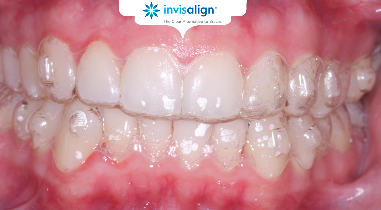 braces invisalign invisible teeth almost write ace orthodontics ireland leave ie
